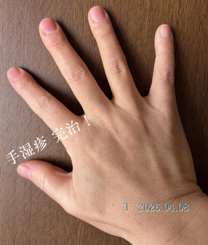 手湿疹を乗り越えよう ばっちり治った手湿疹
