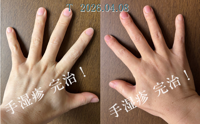 手湿疹が完治した両手の写真